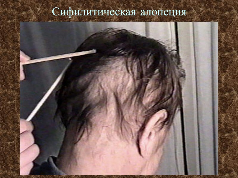 Сифилитическая алопеция